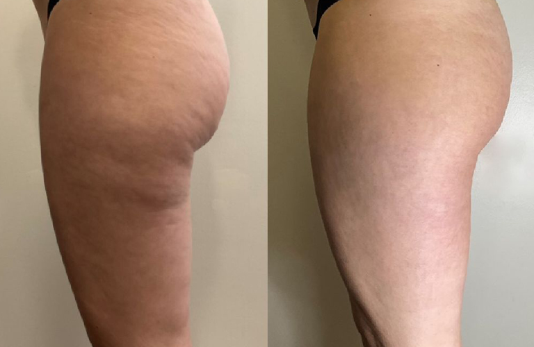 before after