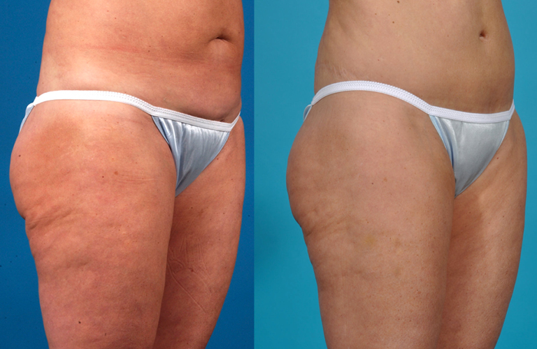 before after2