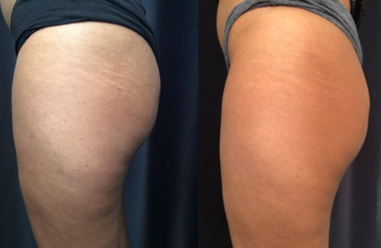 before after3